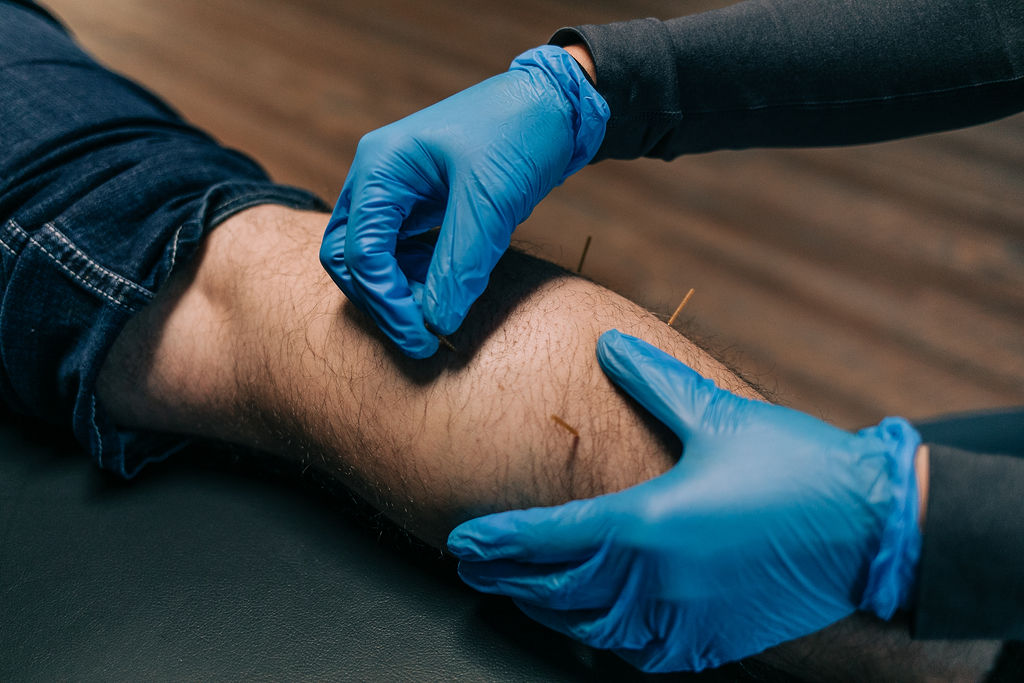 Dry needling leg